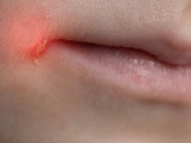 Impetigo
